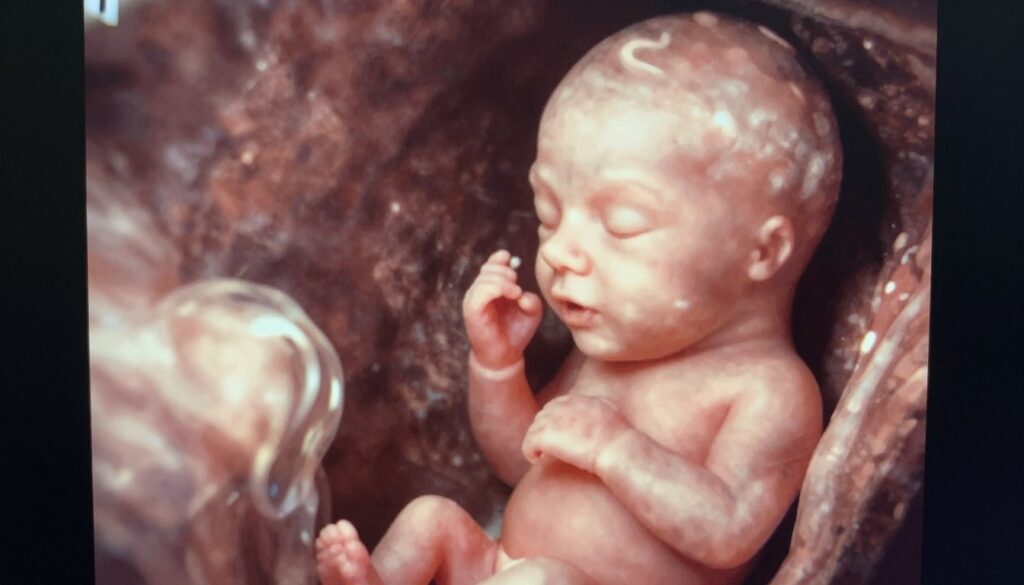 A detailed 3D ultrasound image of a fetus in the womb, showcasing the clarity and intricacy of the visualization. In the foreground, focus on the fetus, highlighting its features such as the outline of the face, limbs, and body position, demonstrating advanced imaging technology. The middle layer includes the surrounding amniotic fluid, appearing soft and translucent, which adds depth to the scene. In the background, a soft gradient of muted colors simulates the uterine environment. The lighting is soft and diffused, mimicking natural light for a calming atmosphere. The angle is a slight side view, capturing the profile of the fetus while avoiding any intrusive elements, maintaining a professional depiction suited for educational purposes. A detailed 3D ultrasound image of a fetus in the womb, showcasing the clarity and intricacy of the visualization. In the foreground, focus on the fetus, highlighting its features such as the outline of the face, limbs, and body position, demonstrating advanced imaging technology. The middle layer includes the surrounding amniotic fluid, appearing soft and translucent, which adds depth to the scene. In the background, a soft gradient of muted colors simulates the uterine environment. The lighting is soft and diffused, mimicking natural light for a calming atmosphere. The angle is a slight side view, capturing the profile of the fetus while avoiding any intrusive elements, maintaining a professional depiction suited for educational purposes.